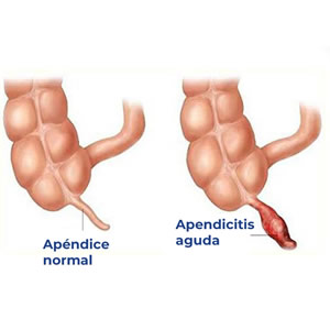 Cirugía de Apéndice