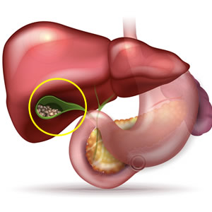 Cirugía de vesícula 