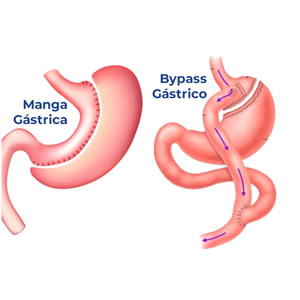 Cirugía de obesidad