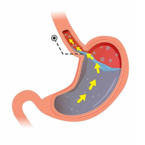 Cirugía de reflujo gastroesofágico