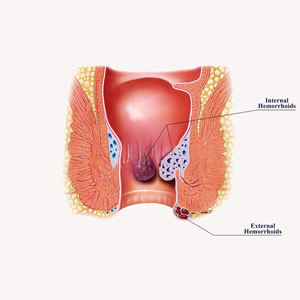Cirugía de hemorroides, fístulas y fisuras