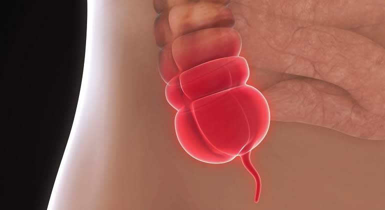 Cirugía de Apéndice