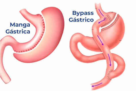 Cirugía de obesidad